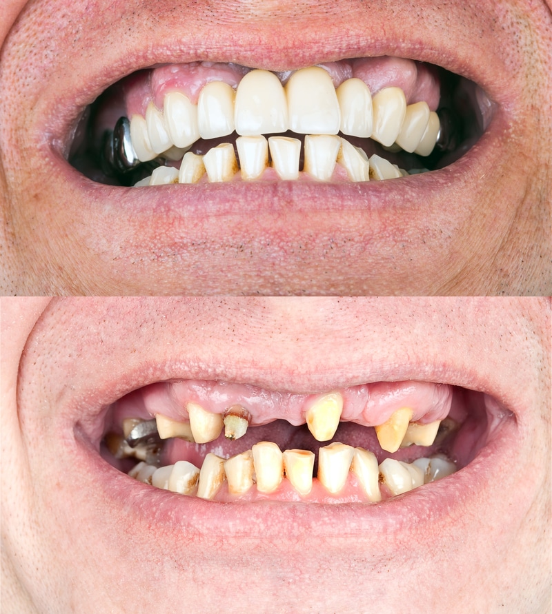 Full Mouth Reconstruction at Dallas Dental Care